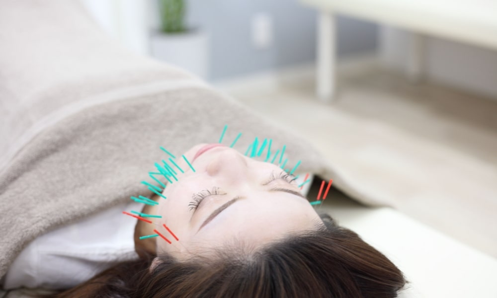 美容鍼を受けている女性