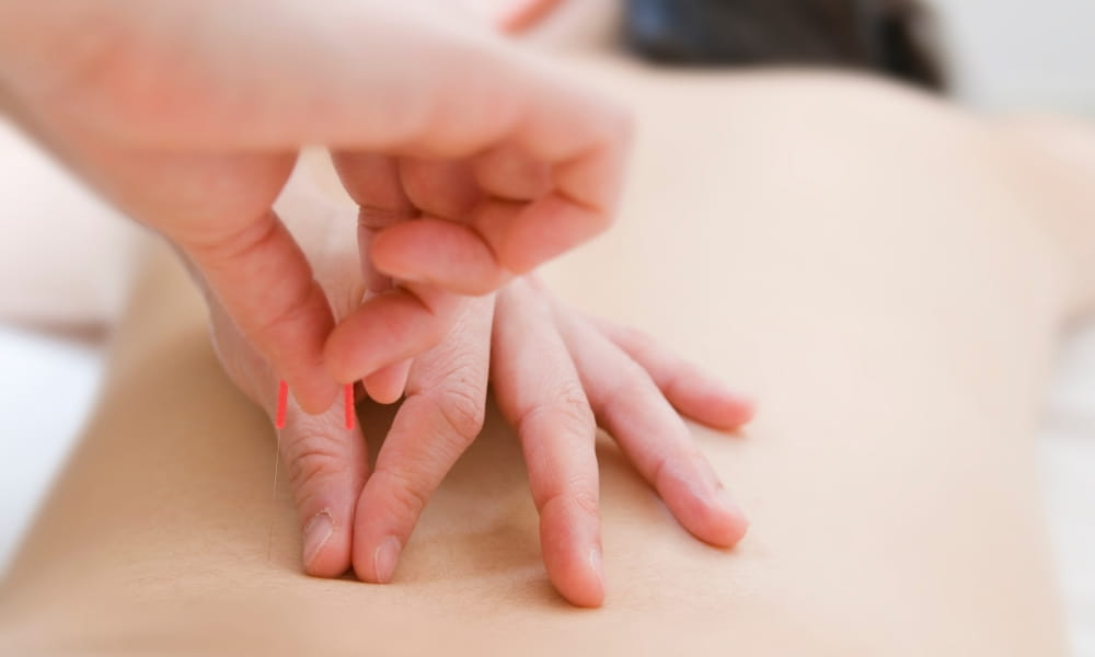 腰痛への鍼治療